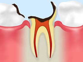 C4【歯根に達した虫歯】