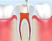 歯の根の清掃