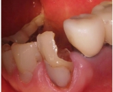 【前歯】歯髄まで虫歯が到達した例