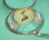 【奥歯】歯髄まで虫歯が到達した例