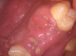 C4　非常に大きな歯牙崩壊　抜歯