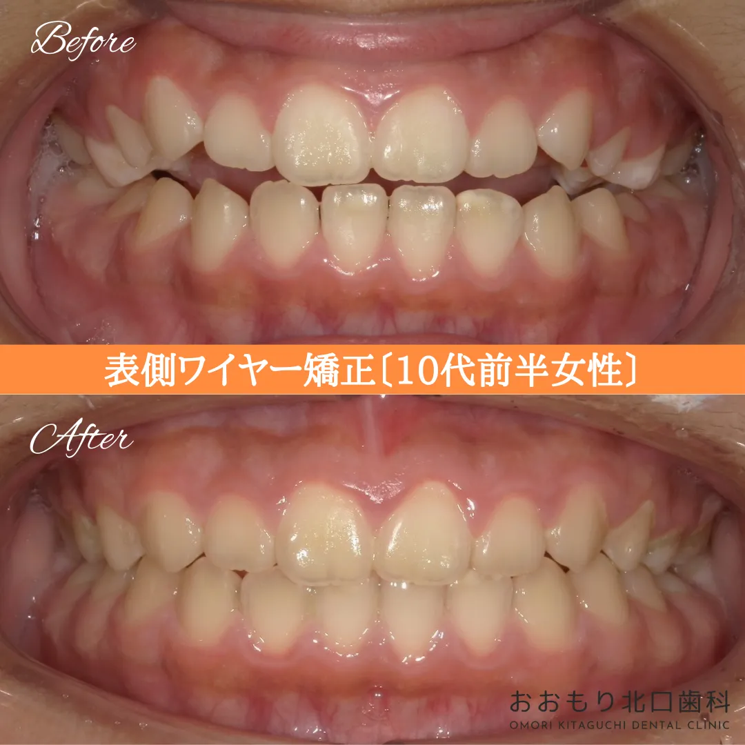 症例紹介⑯フルインビザライン(20代男性) img