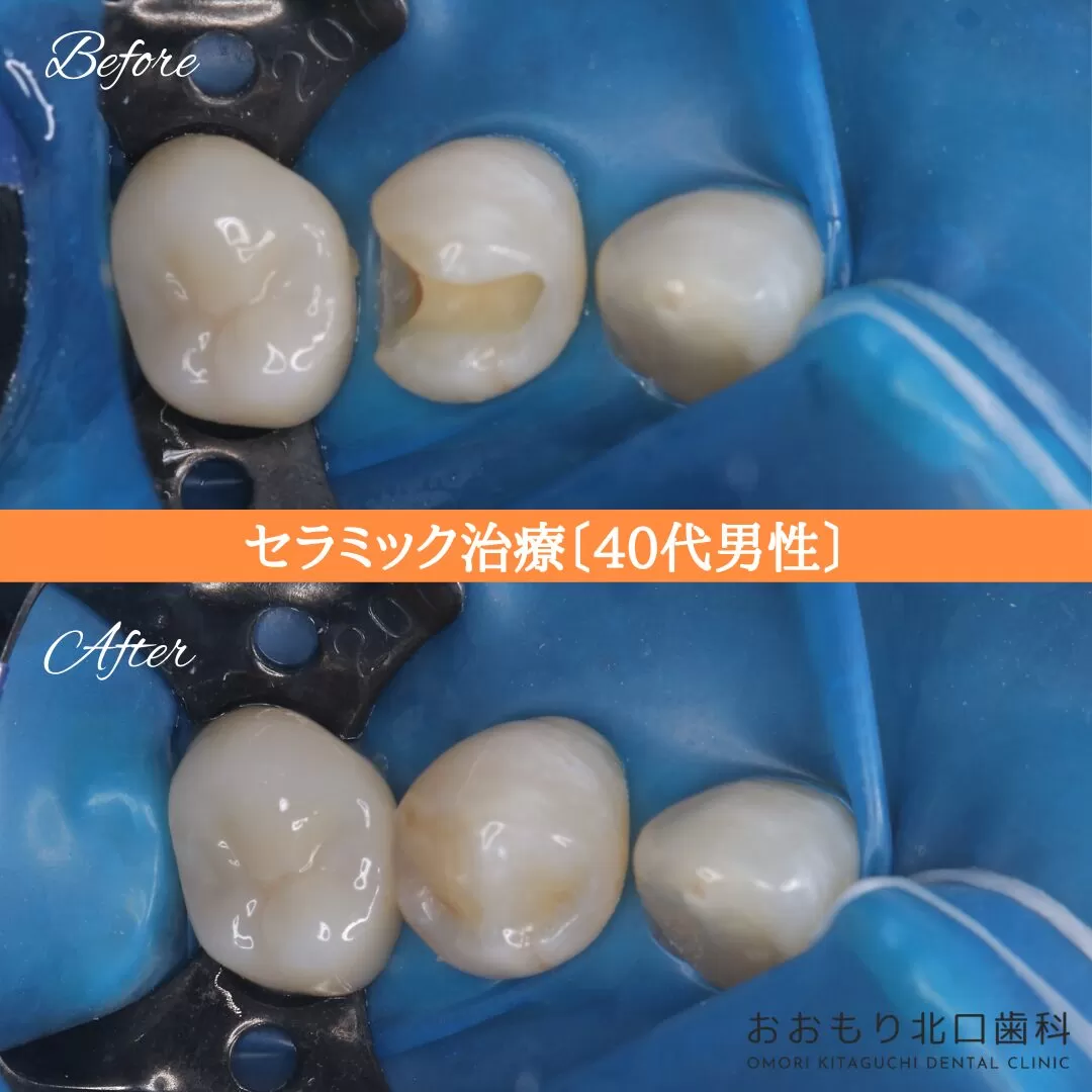 症例⑰ セラミックインレー治療 40代男性 img