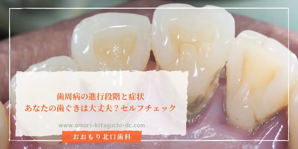 歯周病の進行段階と症状|あなたの歯ぐきは大丈夫?セルフチェック