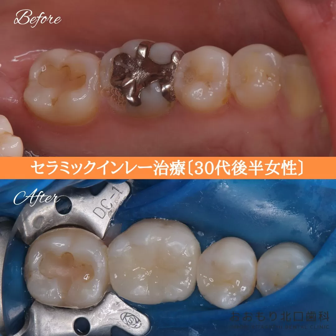 症例② セラミックインレー治療 30代後半女性 img