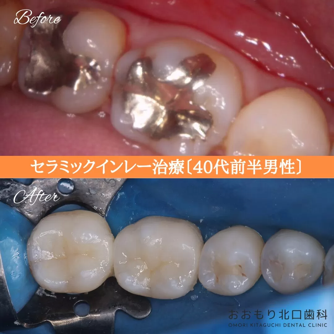 症例④ セラミックインレー治療 40代前半男性 img