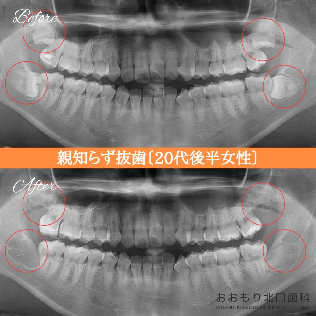 症例紹介㉚親知らず抜歯（20代後半女性） img
