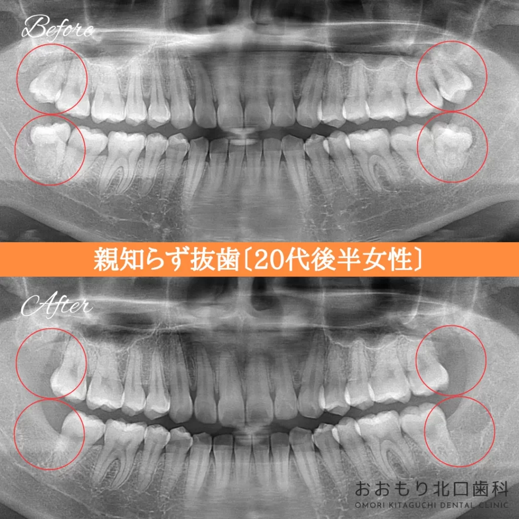 症例紹介㉞親知らず抜歯（20代後半女性） img