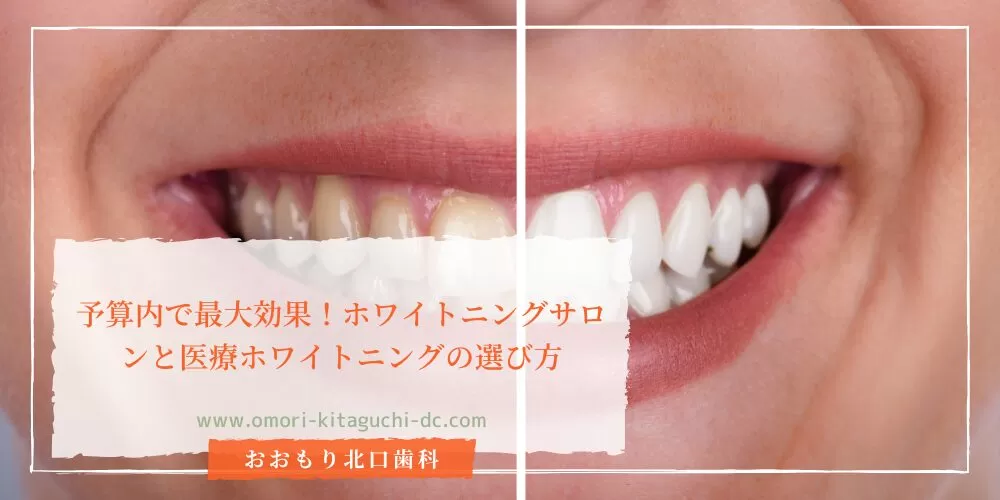 予算内で最大効果!ホワイトニングサロンと医療ホワイトニングの選び方を避けるためのガイドライン