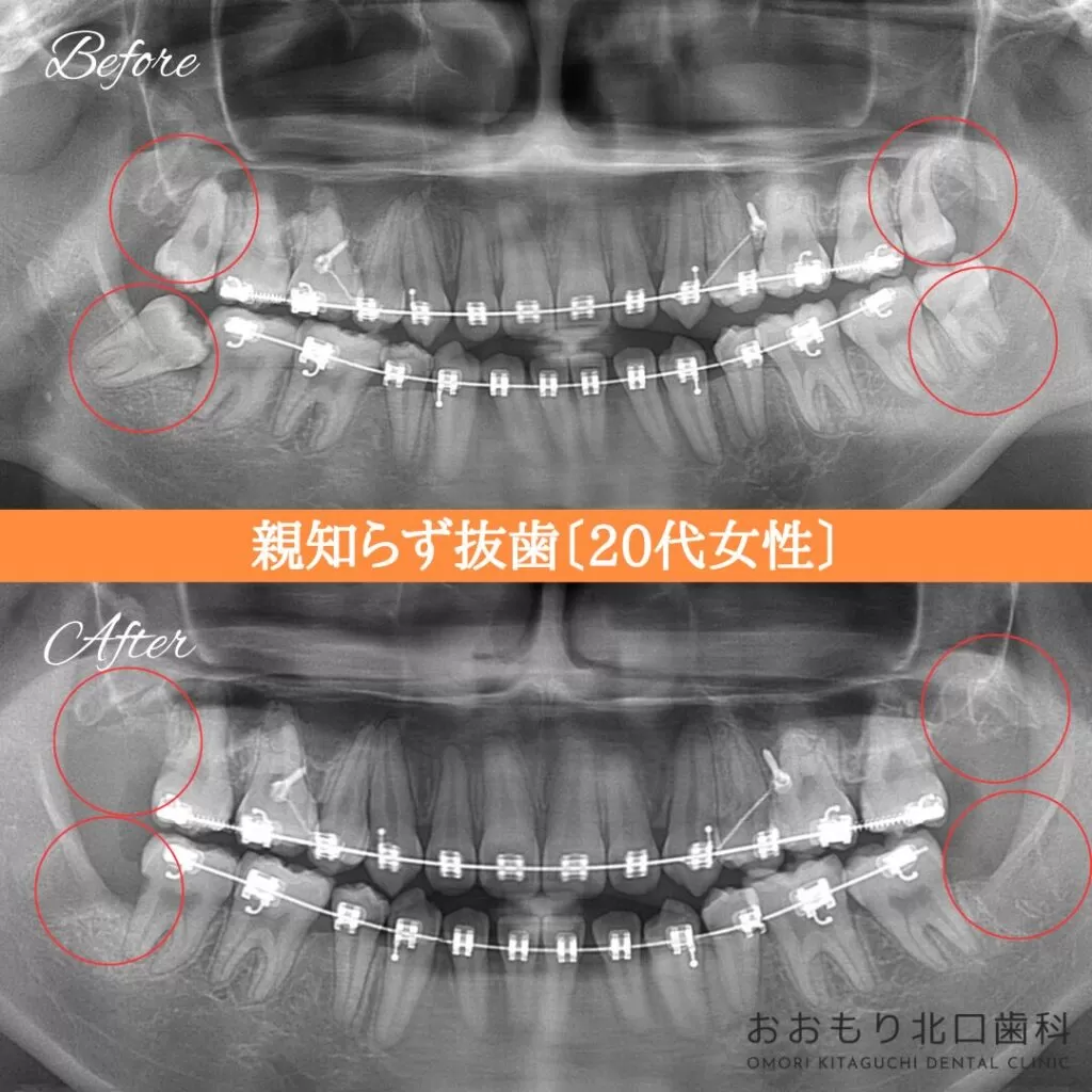 症例紹介㊶親知らず抜歯（20代女性） img