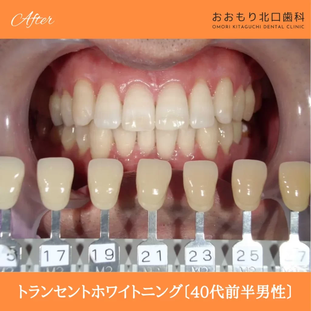 症例紹介60トランセントホワイトニング(40代前半男性)