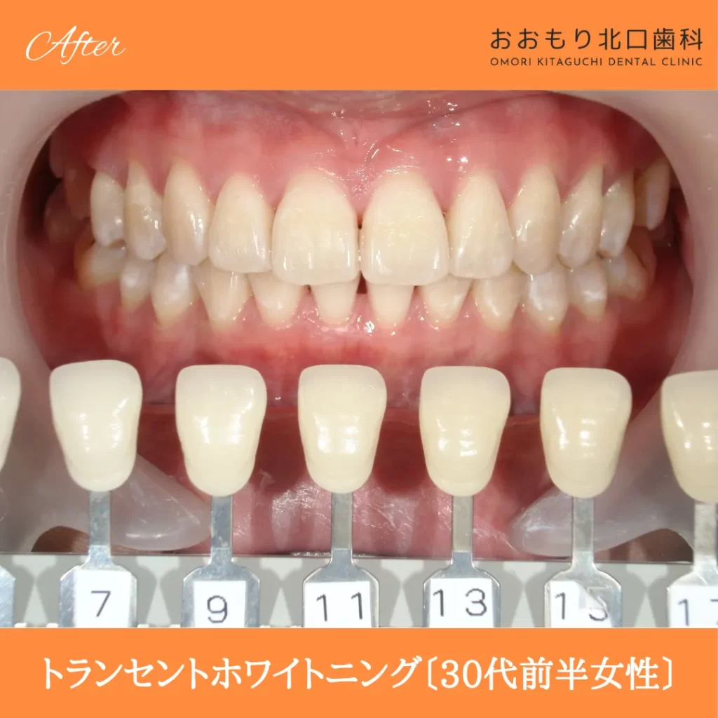 症例紹介75トランセントホワイトニング(30代前半女性)