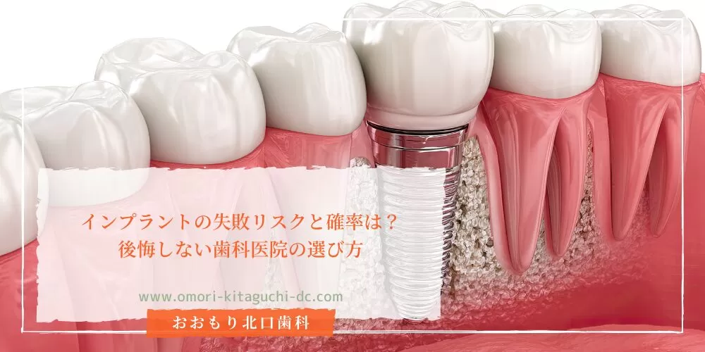 インプラントの失敗リスクと確率は？後悔しない歯科医院の選び方