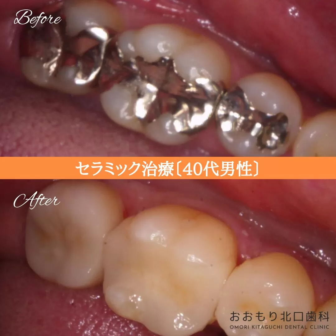 症例⑪ セラミック治療 40代男性 img