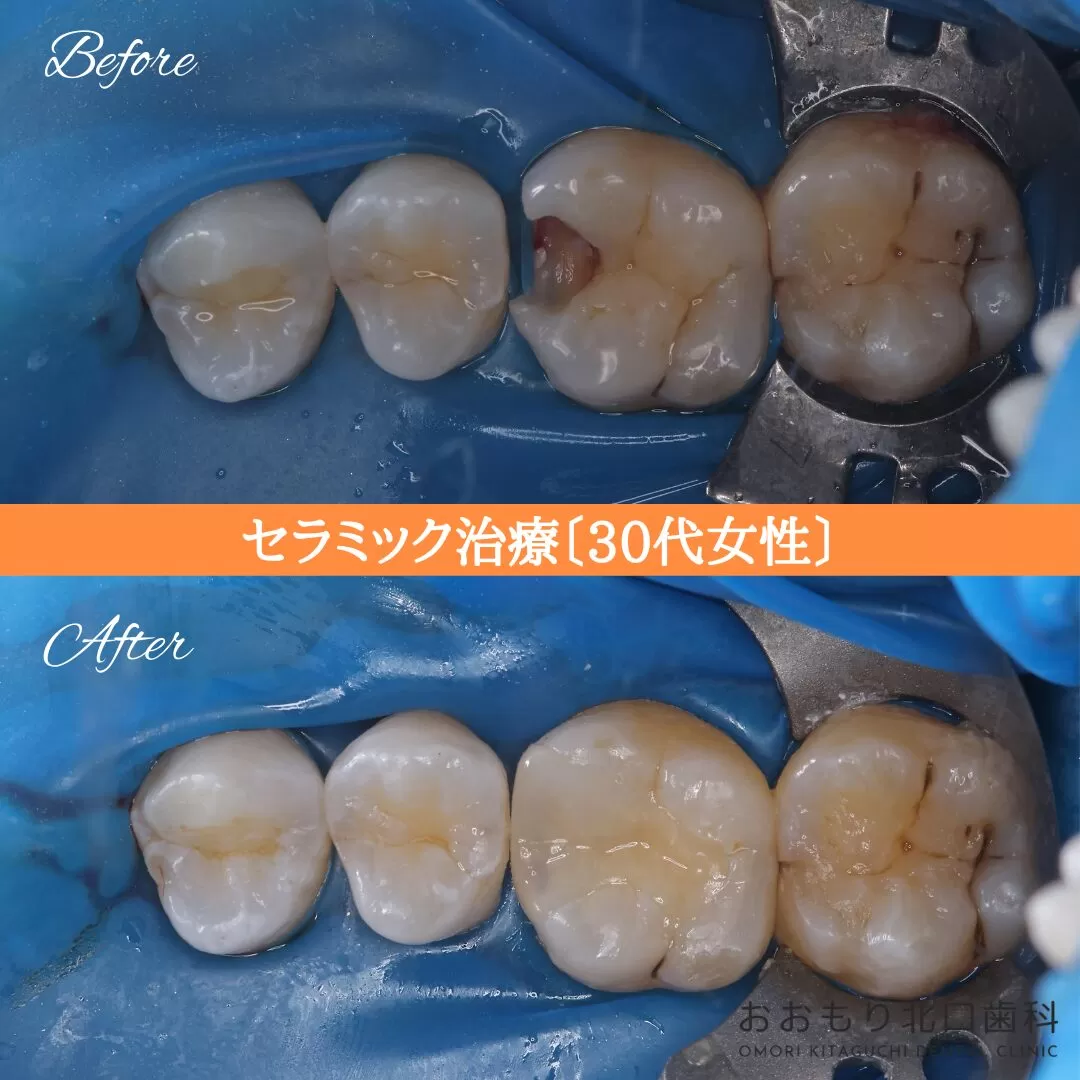 症例㉔セラミックインレー治療 30代男性 img