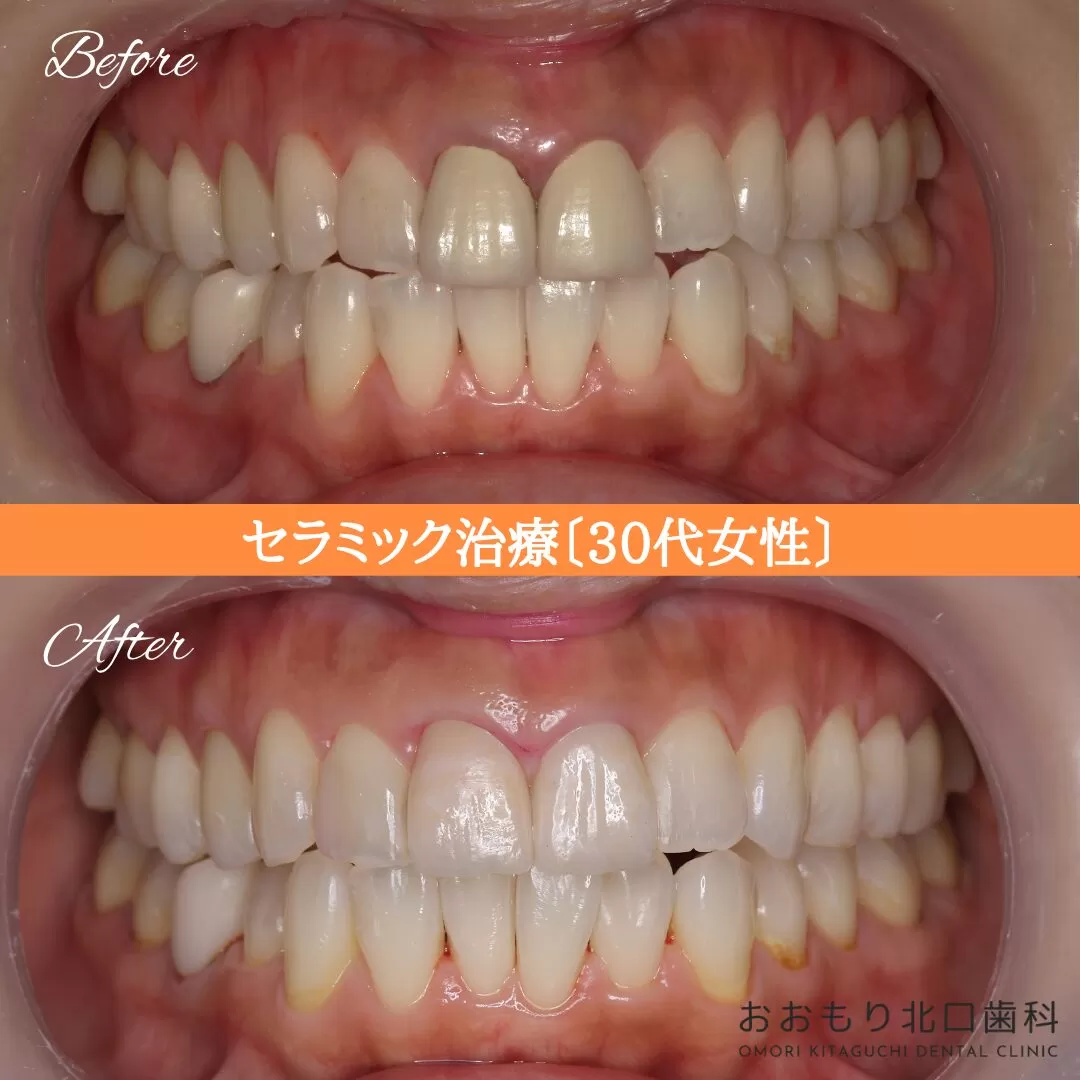 症例⑧ セラミック治療 30代女性 img
