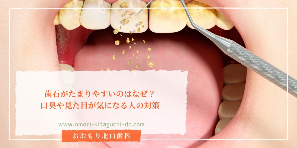 歯石がたまりやすいのはなぜ？口臭や見た目が気になる人の対策 | お