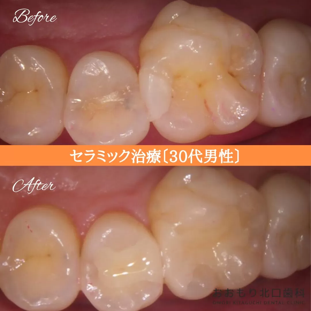 症例⑬ セラミック治療 30代男性 img
