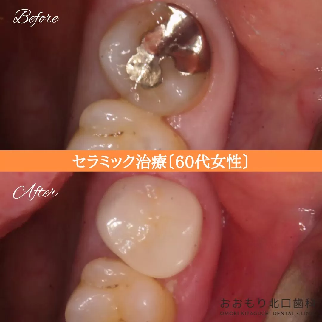 症例⑫ セラミック治療 60代女性 img