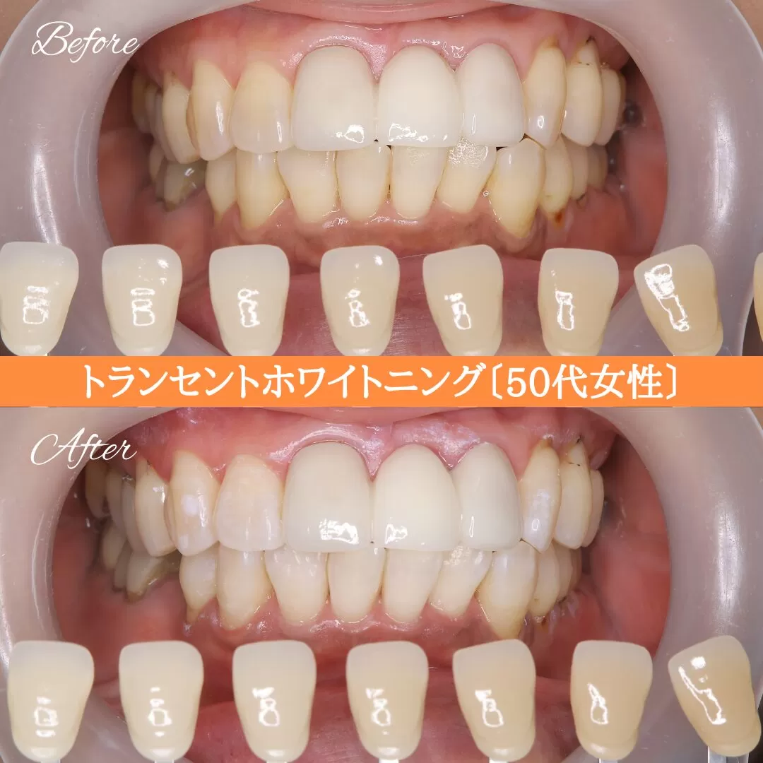 症例紹介96トランセントホワイトニング（50代女性） img