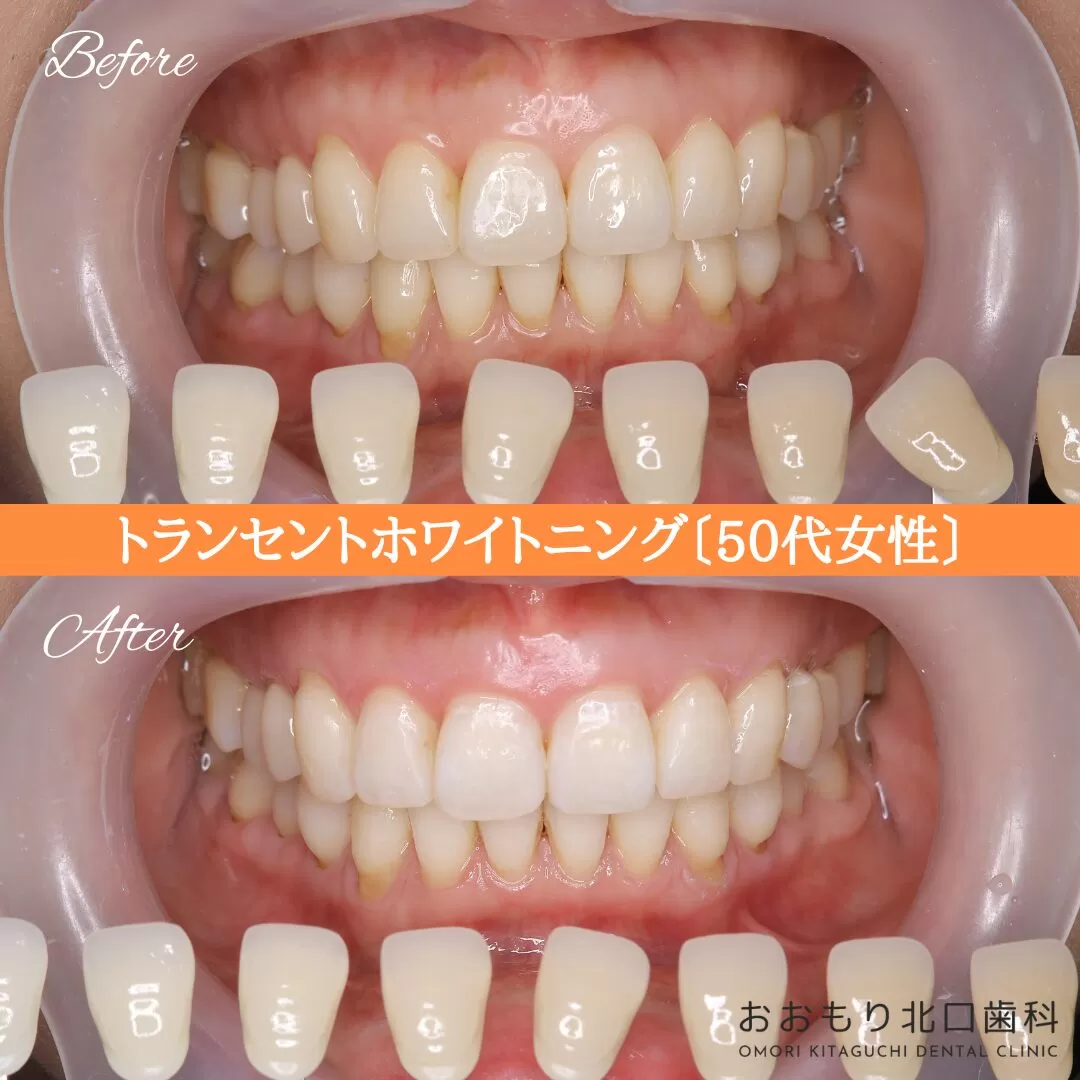 症例紹介97トランセントホワイトニング（50代女性） img