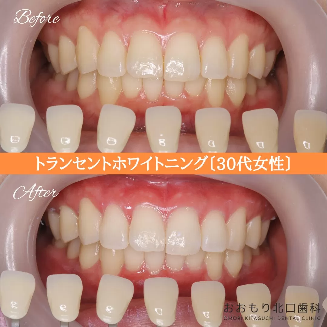 症例紹介98トランセントホワイトニング（30代女性） img