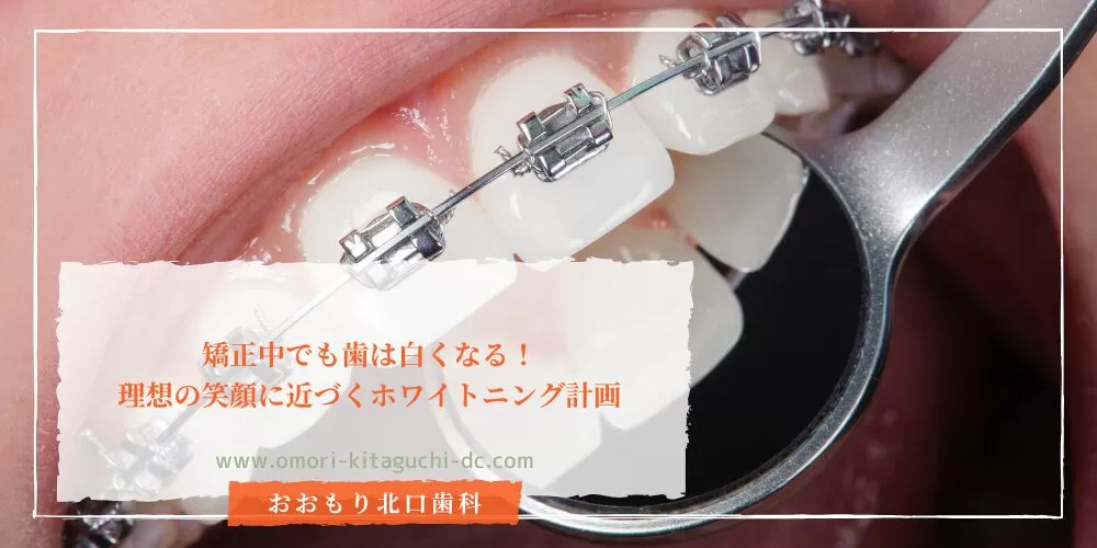 矯正中でも歯は白くなる！理想の笑顔に近づくホワイトニング計画