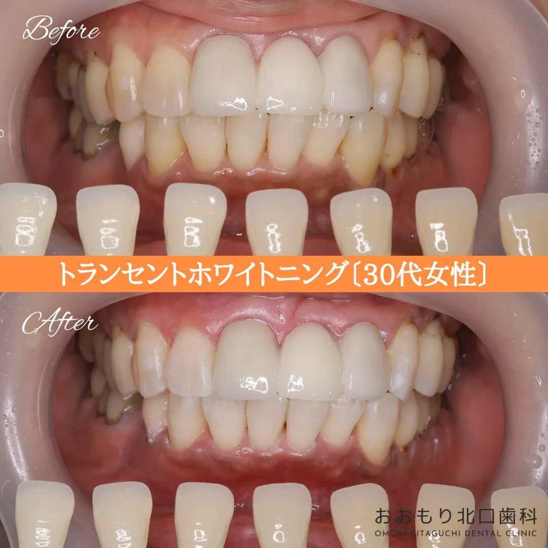 症例紹介99トランセントホワイトニング（30代女性） img