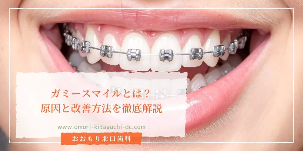 ガミースマイルとは？原因と改善方法を徹底解説