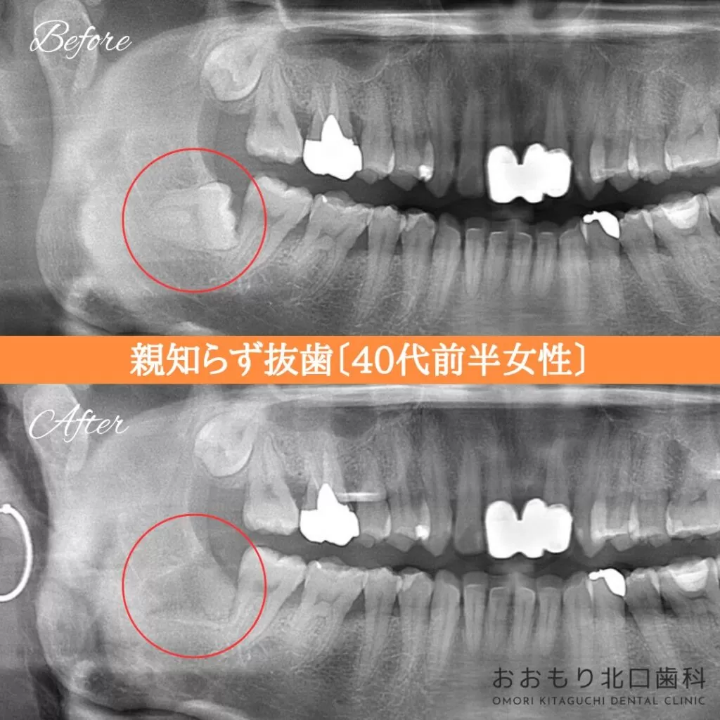 症例紹介⑦親知らず抜歯(40代前半女性) img