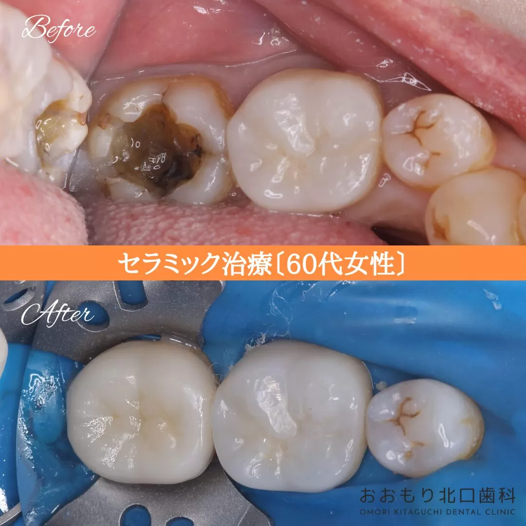 症例㉖セラミック治療 60代女性 img