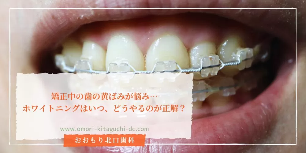 矯正中の歯の黄ばみが悩み…ホワイトニングはいつ、どうやるのが正解？