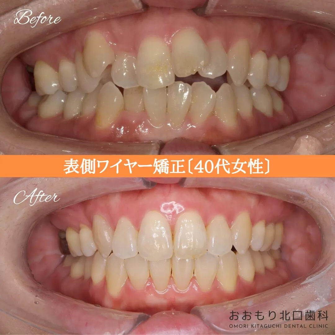 症例紹介⑯表側ワイヤー矯正(40代女性) img