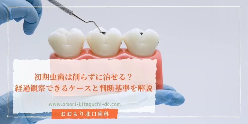初期虫歯は削らずに治せる？経過観察できるケースと判断基準を解説