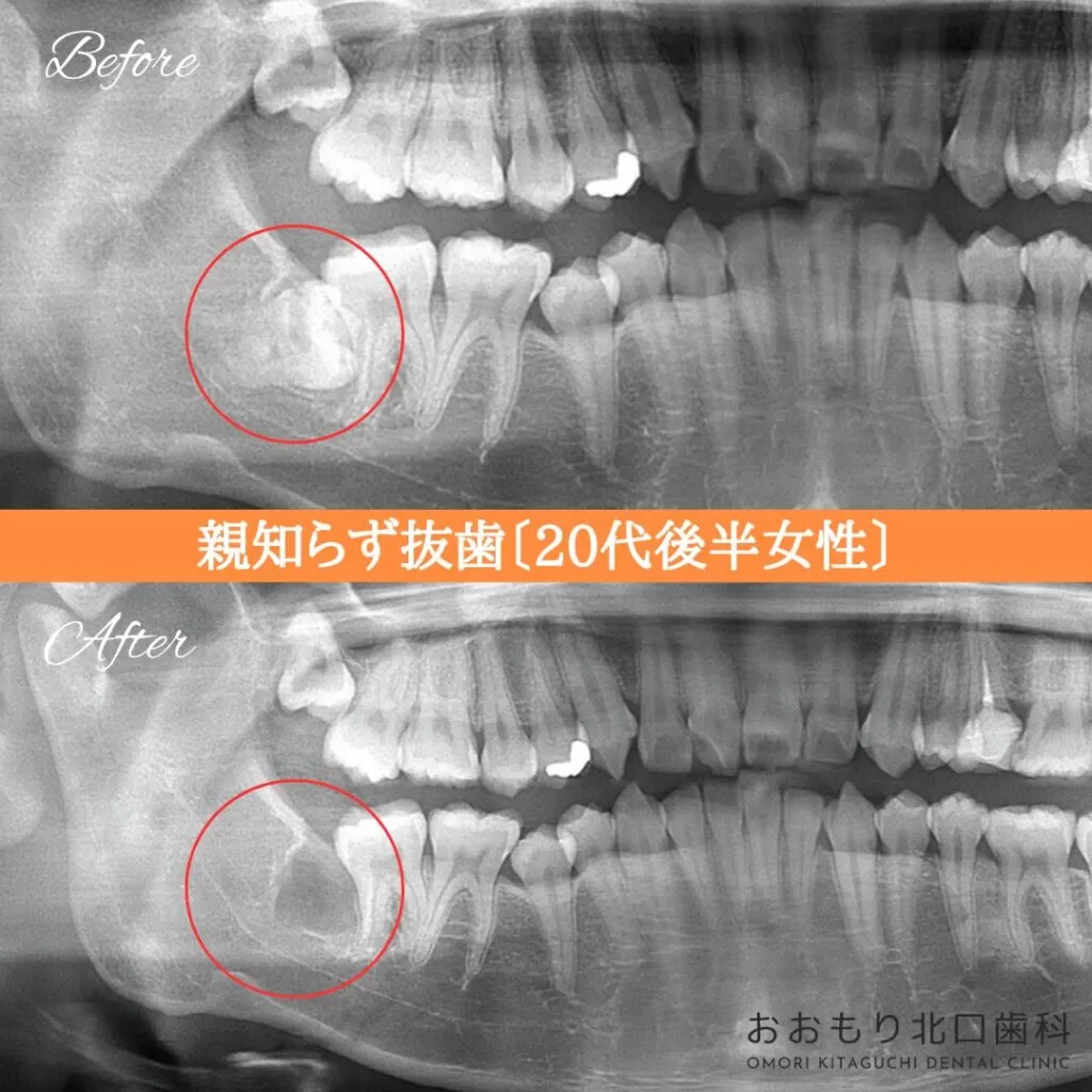 症例紹介⑥親知らず抜歯(20代後半女性) img