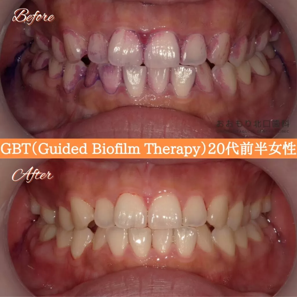 症例紹介⑦GBT(Guided Biofilm Therapy)20代前半女性