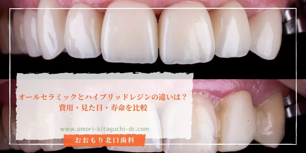 オールセラミックとハイブリッドレジンの違いは？費用・見た目・寿命を比較
