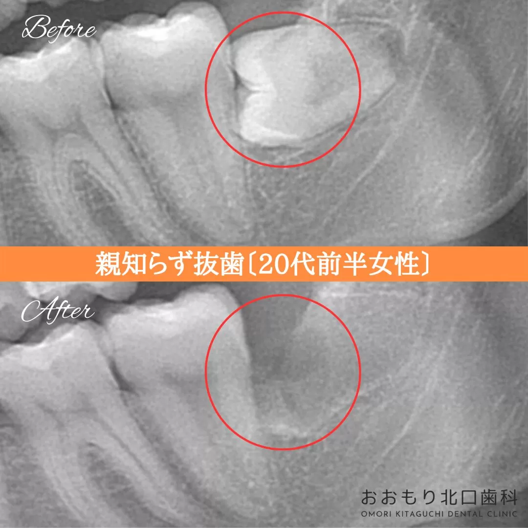症例紹介㉓親知らず抜歯(20代前半女性) img