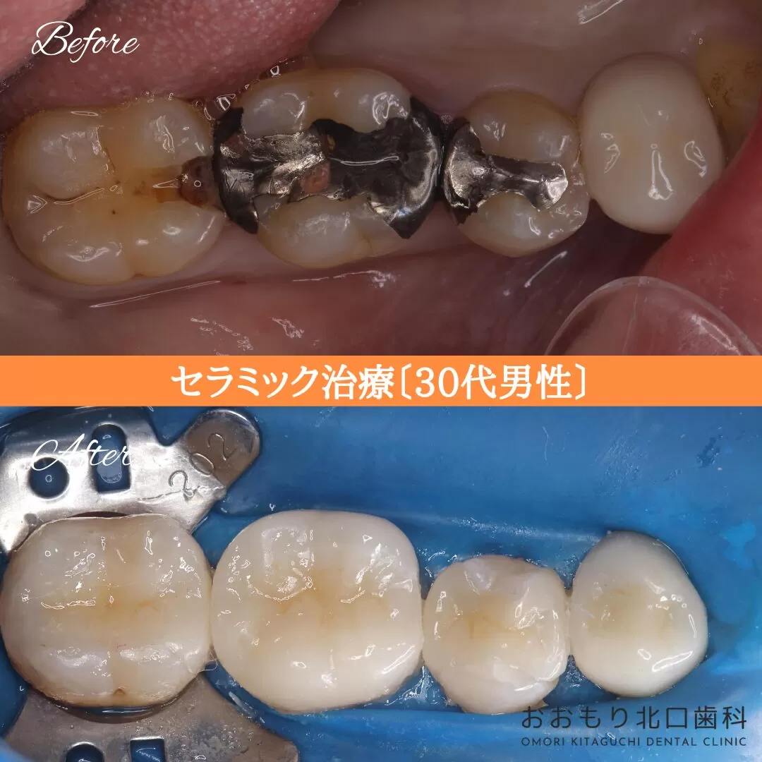症例㉙セラミック治療 30代男性 img