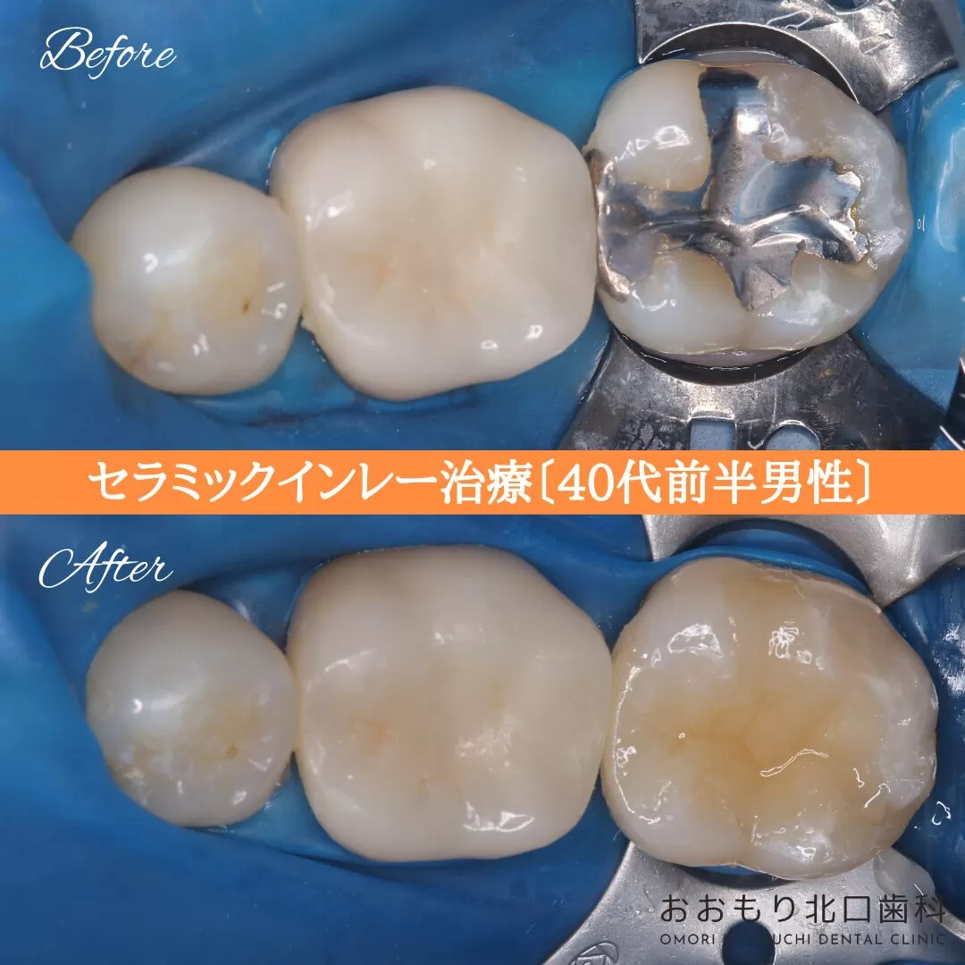 症例① セラミックインレー治療 40代前半男性 img