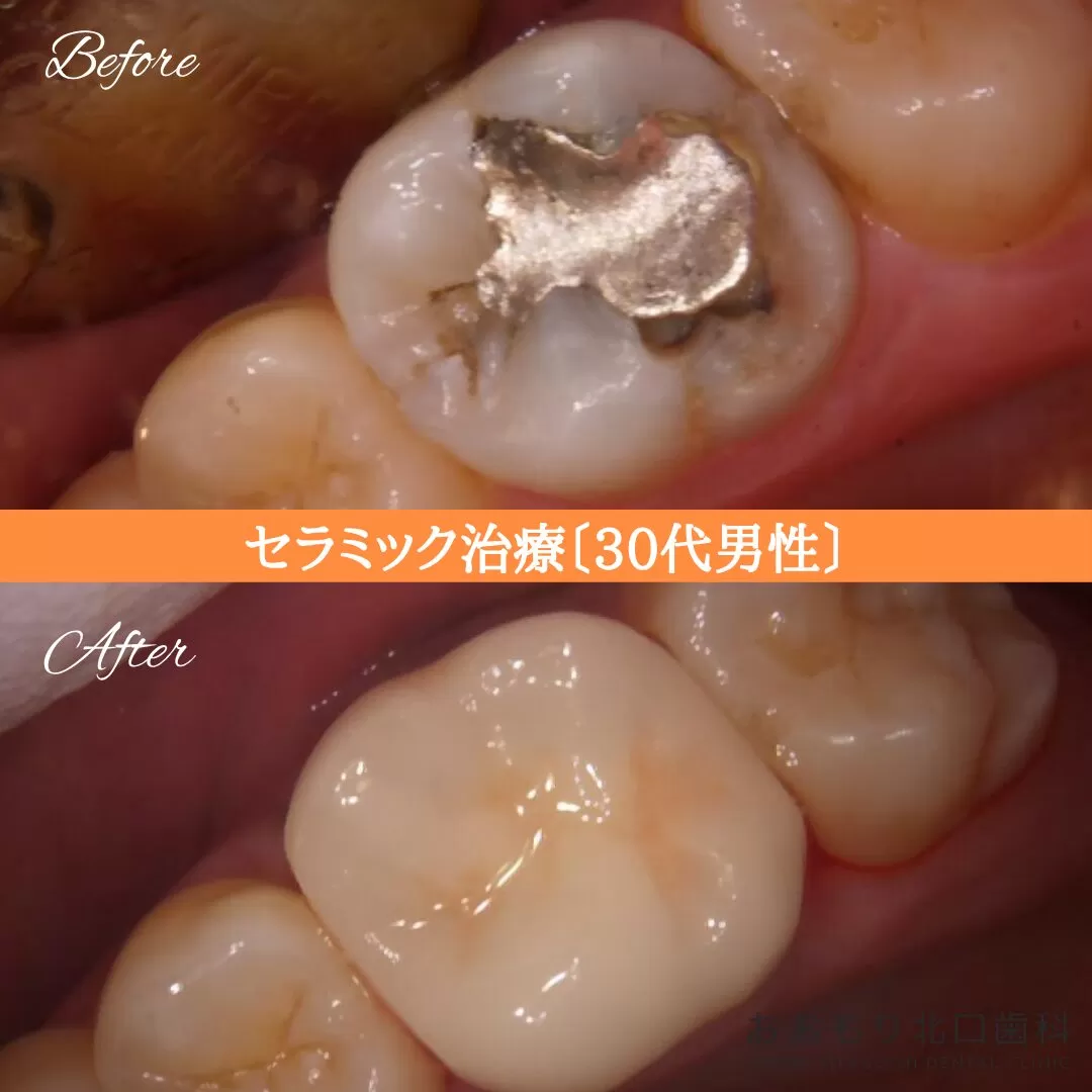 症例⑩ セラミック治療 30代男性 img