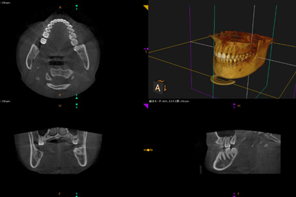 大森駅北口徒歩50秒の歯医者･歯科「おおもり北口歯科」｜歯科用CTを用いた3次元評価でより精度の高い診断を行います