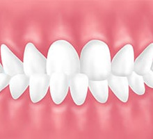 大森駅北口徒歩50秒の歯医者･歯科「おおもり北口歯科」｜交叉咬合（こうさこうごう）
