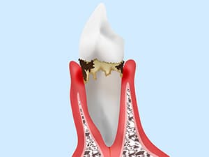 大森駅北口徒歩50秒の歯医者･歯科「おおもり北口歯科」｜軽度歯周炎