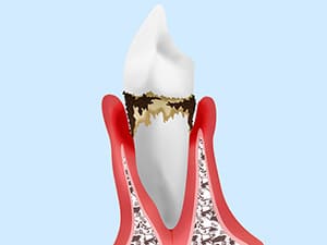 大森駅北口徒歩50秒の歯医者･歯科「おおもり北口歯科」｜中等度歯周炎