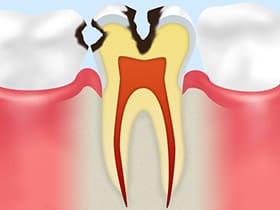 大森駅北口徒歩50秒の歯医者･歯科「おおもり北口歯科」｜C2【象牙質の虫歯】