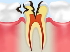 大森駅北口徒歩50秒の歯医者･歯科「おおもり北口歯科」｜C3【神経に達した虫歯】