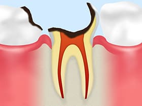 大森駅北口徒歩50秒の歯医者･歯科「おおもり北口歯科」｜C4【歯根に達した虫歯】