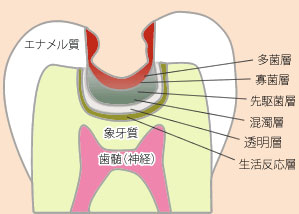 大森駅北口徒歩50秒の歯医者･歯科「おおもり北口歯科」｜う蝕の6層について